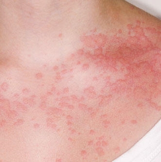 ragtapasz allergia kezelése