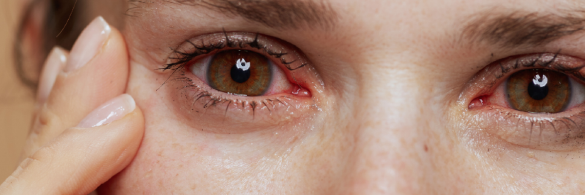 Vörös, könnyező szemek: így támad az allergia