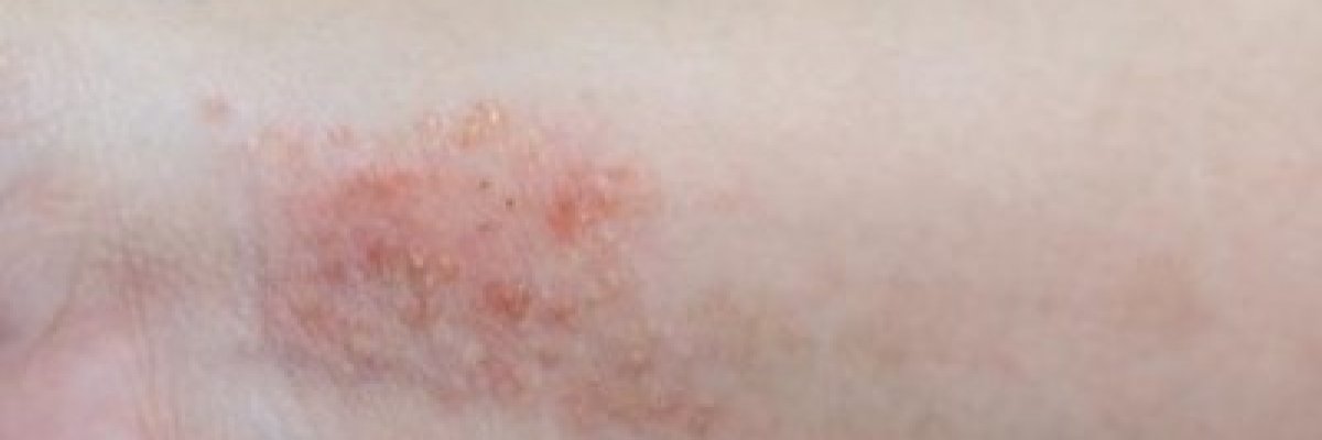 pikkelysömör tüneteinek kezelése bőr sapka pikkelysömör a lábon hogyan kell kezelni