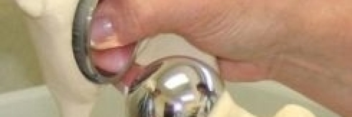 Az ortopédiai implantátumok allergiát okozhatnak