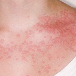 Még mindig sok a félreértés az allergiákkal kapcsolatban