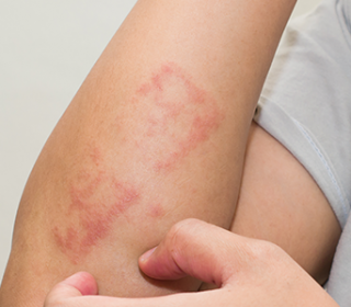 bőrkiütés vörös foltok formájában felnőttek kezelésében pikkelysömör kezelése tüneteket okoz