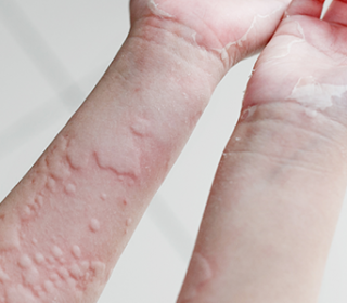 piros kerek folt a kezén viszket vitiligo pikkelysömör kezelése