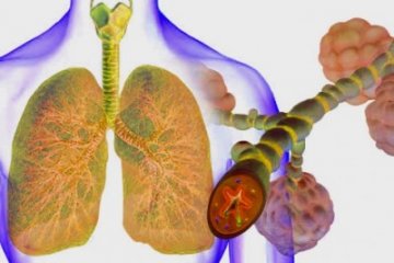 Az allergiás asztma megismertetését célzó kampány zajlik több európai országban