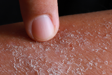 Nikkel allergia miatt is lehet foltokban vörös, száraz a bőre!