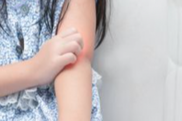 Atópiás dermatitisz vagy ekcéma? Ismerni kell az allergiás hátteret 