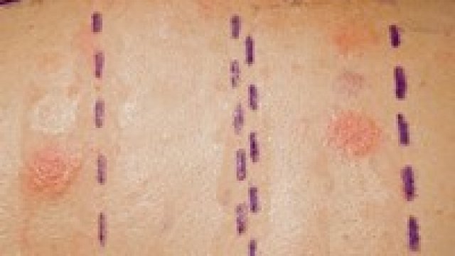 Miért fontos tartós tetoválás előtt allergiavizsgálatot végeztetni?