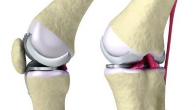Implantátumra vár? Műtét előtt végeztessen fémallergia vizsgálatot!