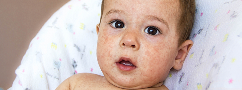 A baba hozzátáplálás buktatói: allergia, lisztérzékenység | Allergia és életmód