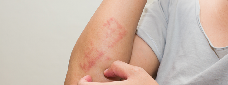 allergiás bőrgyulladás és annak kezelése a cukorbetegek