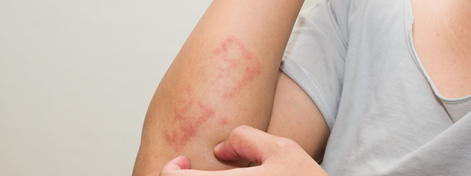 Pikkelysömör (pszoriázis, psoriasis) tünetei és kezelése