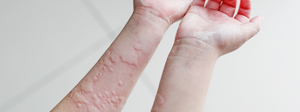 allergiás dermatitis az ujjak között