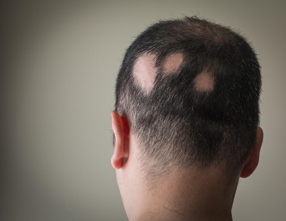 alopecia areata, foltos hajhullás, kopaszodás