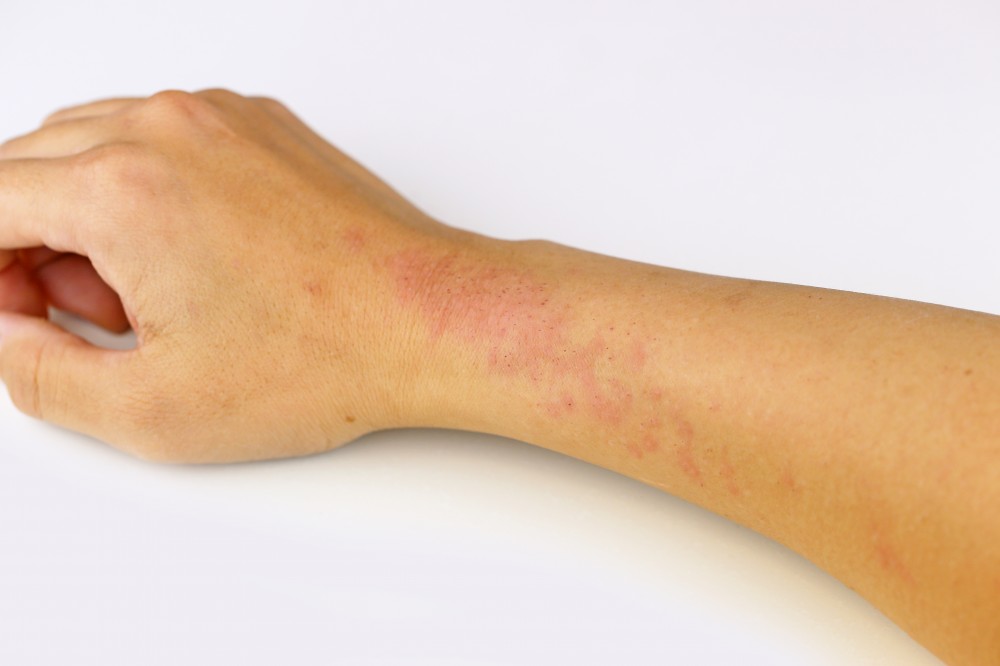 allergiás ekcéma okai hogyan lehet eltávolítani a vörös foltokat a benőtt haj után