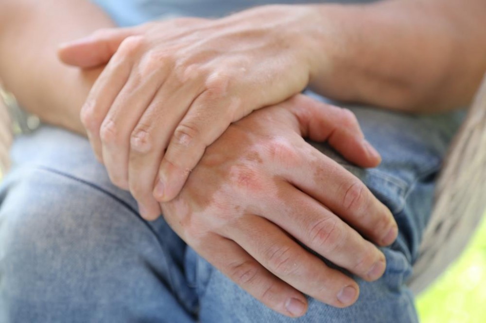 vitiligo, foltos kéz, gluténérzékenység, lisztérzékenység