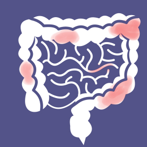 a crohn-betegség nem fogyhat le