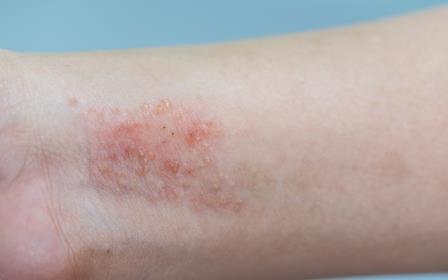 allergiás ekcéma kezelése házilag az idsek pikkelysömör kezelésére