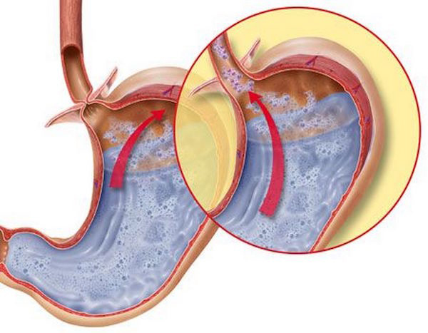 5 kevésbé ismert reflux tünet